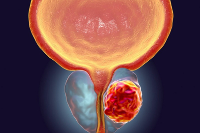 Uzmanı uyardı: Prostat kanseri tedavisini geciktirmeyin