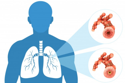 Prof. Dr. Kayhan: KOAH tedavi edilebilir bir hastalıktır