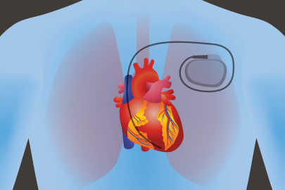 Kalp pili kalbin ritminde oluşan anormalliği düzeltiyor