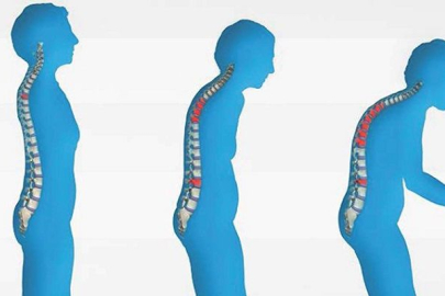 Osteoporoz için 'kemiğiniz kırılmadan önlem alın' uyarısı