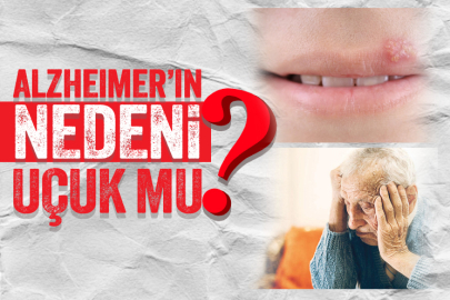 Uçuk Alzheimer'a neden olabilir!