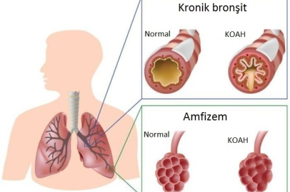 KOAH tedavisinin ilk basamağı tütün ve mamullerini bırakılmak!