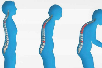 Kavanoz açamıyorsanız osteoporoz riskiniz artmış demektir