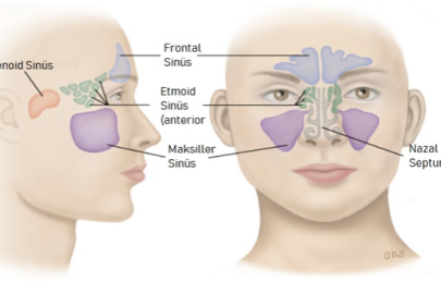 Sinüzit vakalarını tetikleyen 5 etken