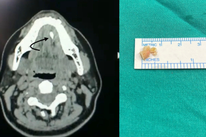 Ağızdaki tehlike: Tükürük bezi taşı hastalığı