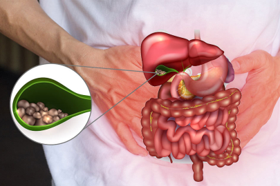 Safra kesesi ameliyatı sonrası beslenmeye dikkat!