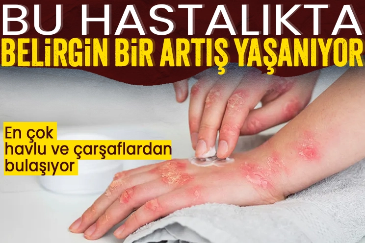 Uyuz hastalığı son yıllarda artış gösteriyor