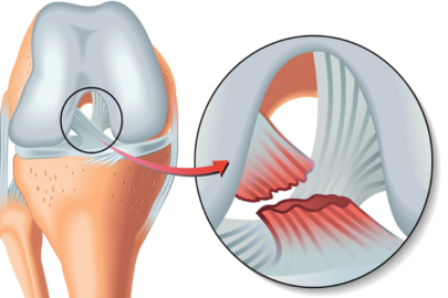 Menisküs yırtıkları kireçlenmeye neden olabilir